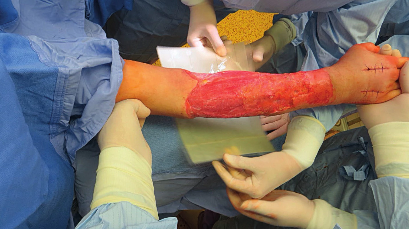 The process of Integra® application in a full-thickness burn on the forearm