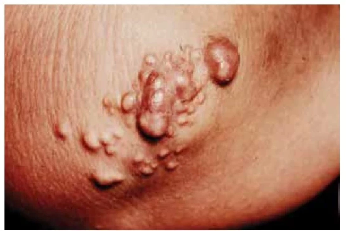 Xanthoma tuberosum