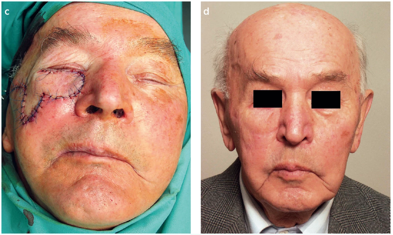 a,b,c,d. Reconstruction of suborbital area using the bilobed flap. (Author’s archive)<br>
a) Preoperative marking, b) During the operation, c) After reconstruction, d) Postoperative result