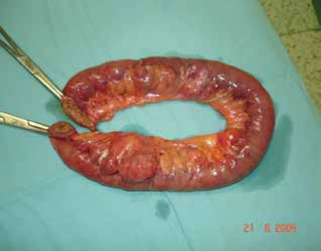 Tenké střevo po resekci<br>
Fig. 2: Small bowel after resection