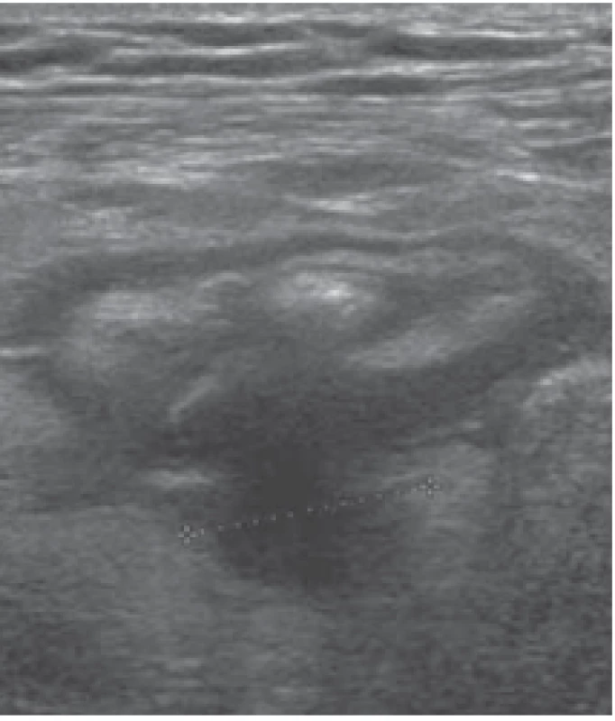 Ultrasonografi cké vyšetření
břicha, obraz divertiklu na colon sigmoideum, s jemným prosáknutím
tuku v okolí, lehce zesílenou stěnou
segmentu sigmoidea, bez dalších
komplikací – lehká divertikulitida.<br>
Fig. 8. Ultrasonographic examination of
the abdomen, imaging a diverticulum
on the sigmoid colon, with a fi ne infi ltration of fat into the surroundings, and
a slightly thickened wall of the sigmoid
segment, without any other complications – mild diverticulitis.