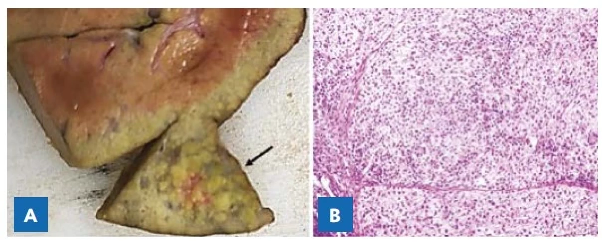 A – Solitární ložisko hepatocelulárního karcinomu (šipka)
v levém laloku jater u čtrnáctiměsíčního chlapce s tyrosinemií typ 1.<br>
B – Mikroskopický obraz dobře diferencovaného hepatocelulárního
karcinomu. Hematoxylin-eozin, pův. zvětšení 400×.