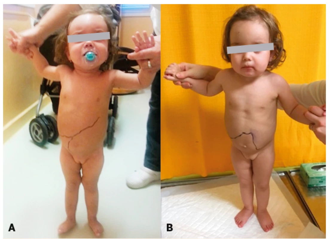 A. Pacientka s Morbus Gaucher – organomegália v čase diagnostikovania
ochorenia (vľavo). 2 B. Pacientka s Morbus Gaucher – ústup organomegálie
po 12 mesiacoch ERT terapie (vpravo).<br>
Fig. 2. A. Patient with Gaucher disease – organomegaly at the time of diagnosis
(left). 2 B. Patient with Gaucher disease – reduction of organomegaly after
12 months of ERT (right).