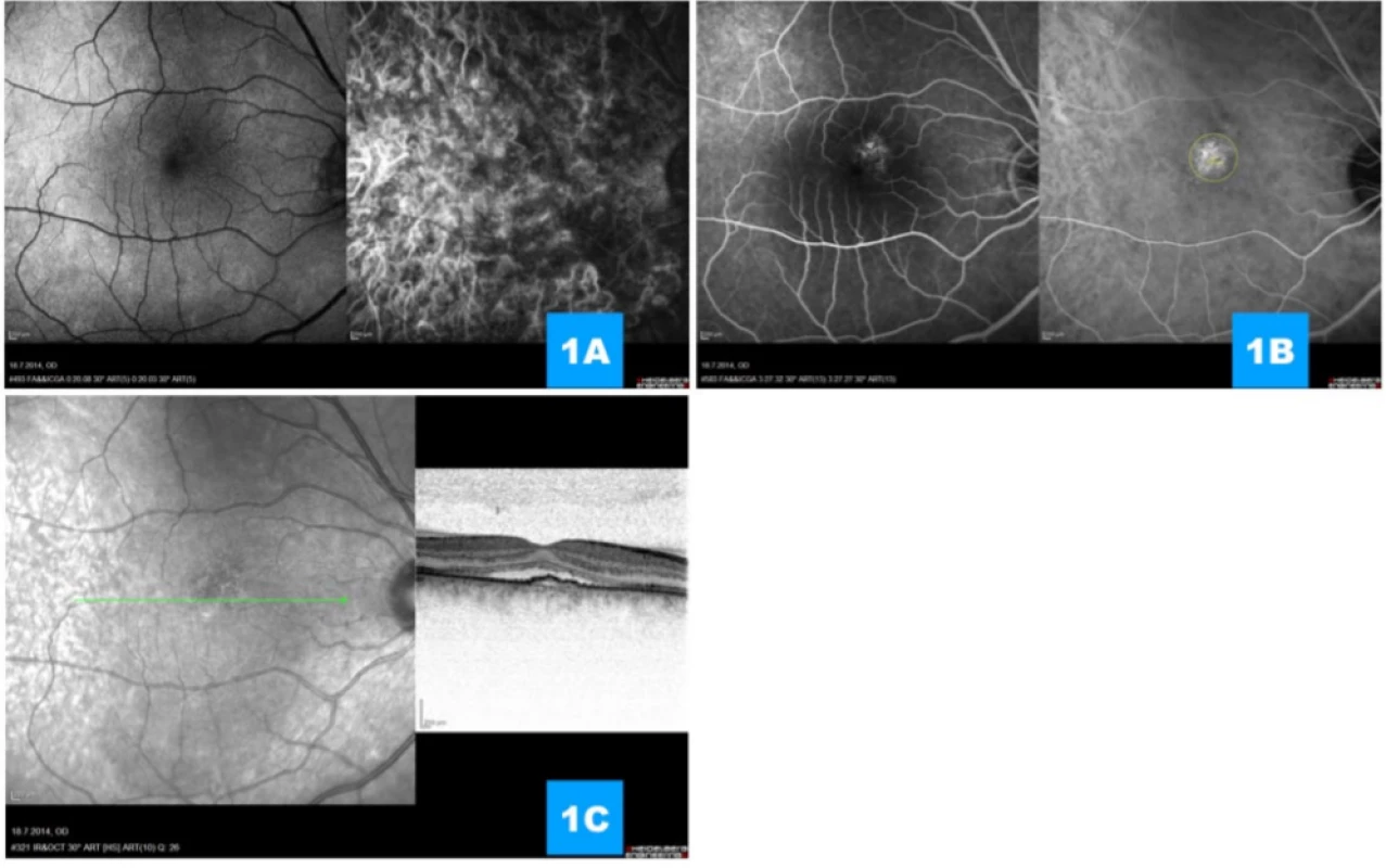 (A) Simultaneous fluorescence and indocyanine angiography in prearterial and
(B) late venous phase of angiogram displays rounded subfoveal deposit of gradual hyperfluorescence with demarcated
width of beam for photodynamic therapy (yellow outlining), on angiogram there are no signs of choroidal neovascularisa- tion (C) Transfoveal linear scan demonstrating undulating line of retinal pigment epithelium, subretinal fluid and relatively
well preserved individual retinal layers