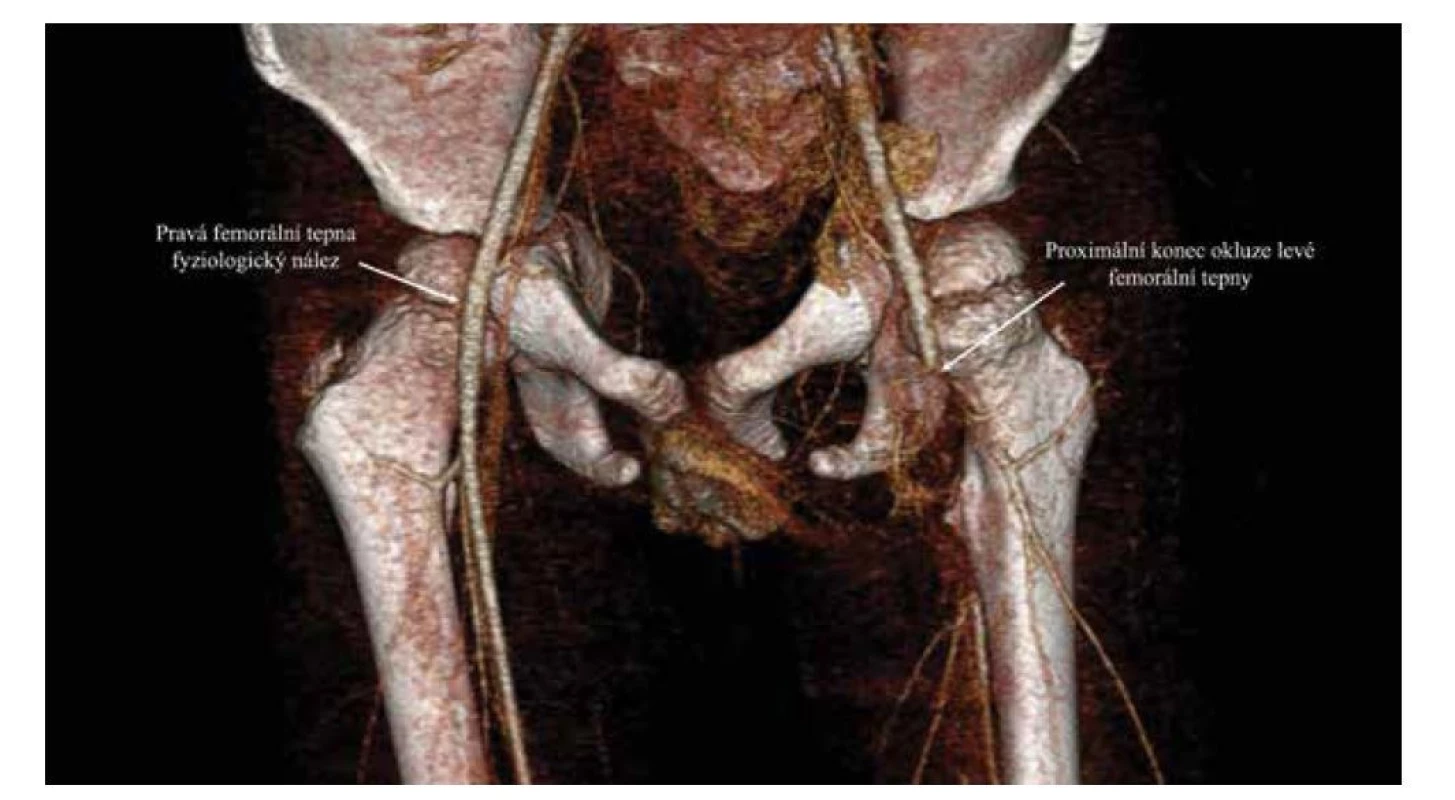CT angiografie, trojrozměrná rekonstrukce. Zachycena neprostupující kontrastní látka při okluzi levé femorální
tepny.<br>
Fig. 3. CT angiography, three-dimensional reconstruction. Occlusion of the left femoral artery.