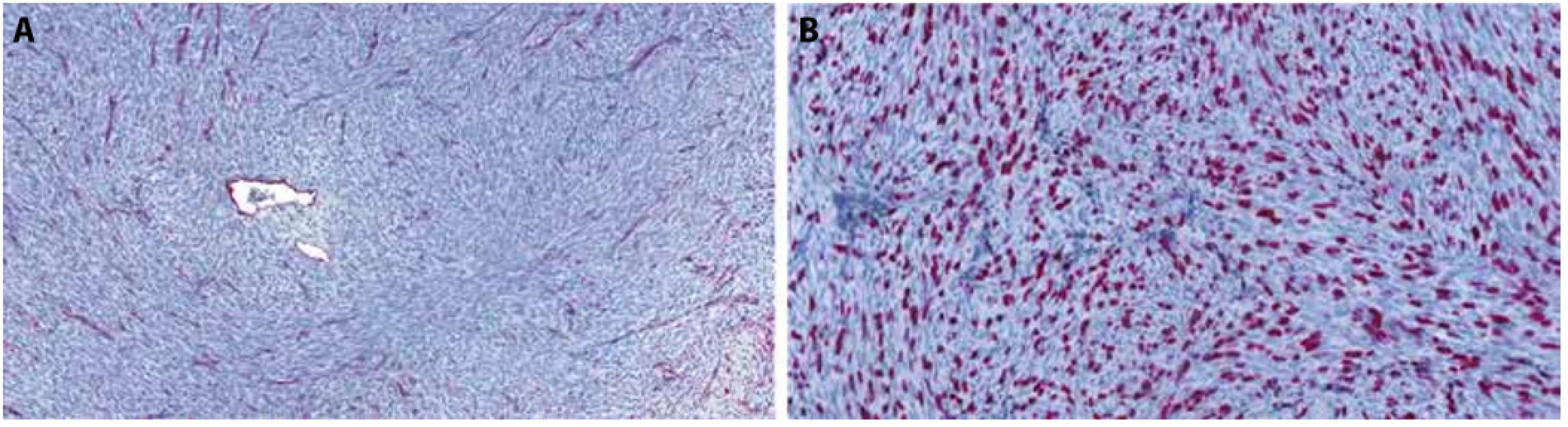 Foto z digitálního scanu histologického preparátu z probatorní biopsie. A – CD34 je pozitivní pouze v endoteliích. B – proliferační aktivita (Ki67) přítomna v hot-spots až v 40 % nádorových buněk. Imunohistochemie CD34, zvětšení 18x (A), imunohistochemie  Ki67, zvětšení 28x (B).