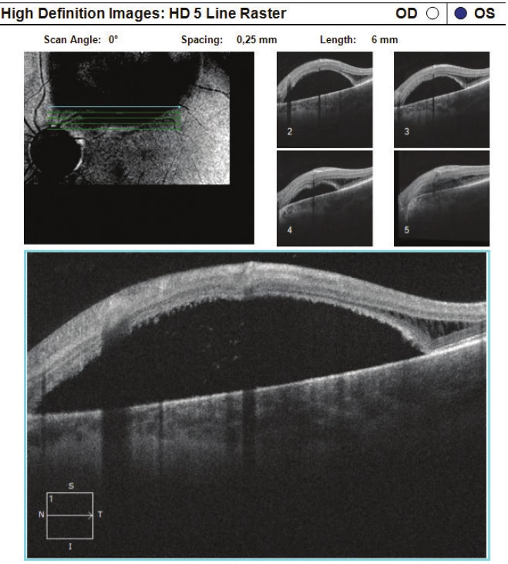 HD-OCT: Linear horizontal trans-retinal scan of left
eye conducted in superotemporal peripapillary region,
with evident extensive area of high serous ablation of neuroretina
with accumulation of fluid sub-retinally, in temporal
regions again evident schisis of retinal layers