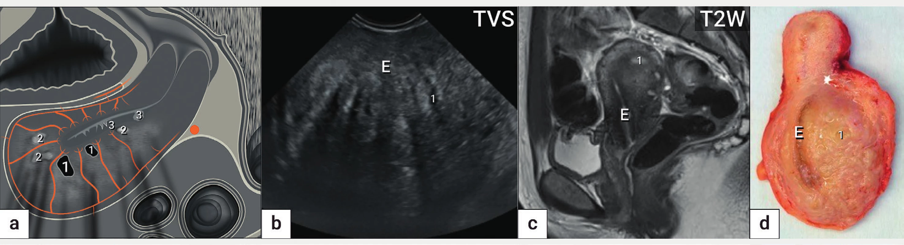 Adenomyóza<br>
Ultrazvukové schéma adenomyózy zadní stěny děložní (a) zobrazující asymetricky zesílenou zadní stěnu děložní na podkladě špatně
ohraničené léze s nehomogenní strukturou s cystickými projasněními (1), hyperechogenními ostrůvky (2), projekcemi endometria do myometria
(3) a jemnými akustickými stíny. Ultrazvukový nález (b), nález z magnetické rezonance (c) a intraoperační nález (d).
E – endometrium, TVS – transvaginální sonografie, T2W – T2 vážené obrazy v magnetické rezonanci