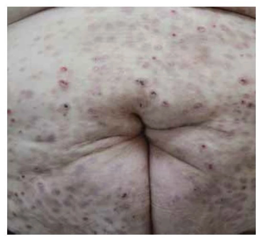 IgA pemphigus