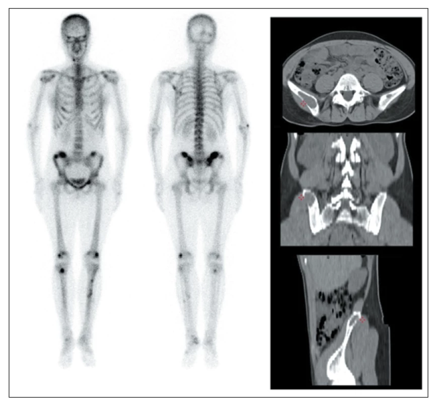 Scintigrafie skeletu a CT u 33leté pacientky s PHPT s hnědými tumory ve skeletu.
Vlevo: celotělová scintigrafie skeletu pomocí 99mTc-HDP (v přední a zadní projekci) s vícečetnými
ložisky patologicky zvýšené akumulace radiofarmaka zejména v oblasti lebky,
v levé lopatce, v pánvi a kostech dolních končetin.<br>
Vpravo: CT vyšetření pánve téže pacientky s průkazem vybraného osteolytického ložiska
v oblasti pravé kosti kyčelní v axiálním, koronálním a sagitálním řezu.