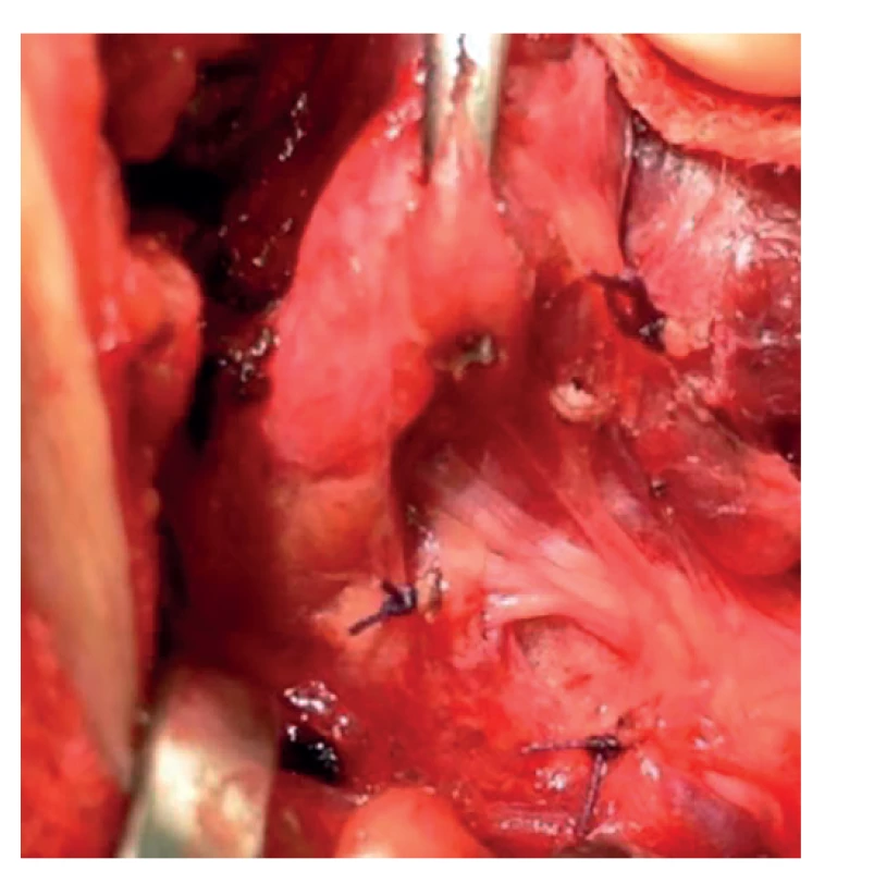 Vrchol TZ mířící na horní příštítné tělísko − typický
(tunelový) průběh NLR<br>
Fig. 3: The top of the TZ pointing at the upper parathyroid
gland – a typical (tunnel-like) course of the NLR