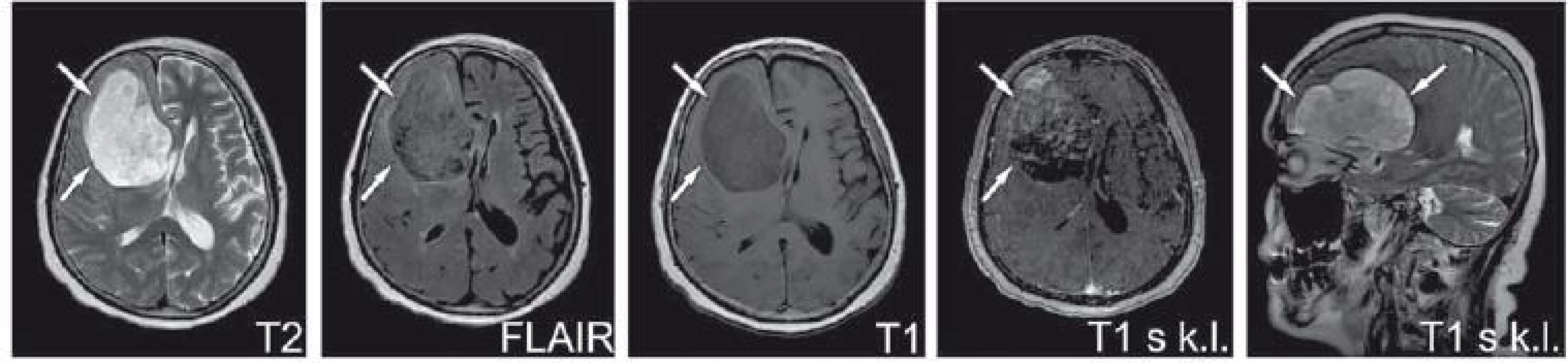 Primární tumor frontálního laloku.