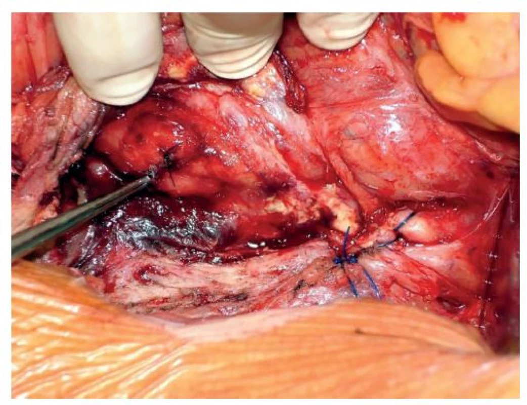 Slepý uzávěr subrenální aorty a sutura duodena<br>
Fig. 2: Blind closure of the subrenal aorta and suture of
the duodenum