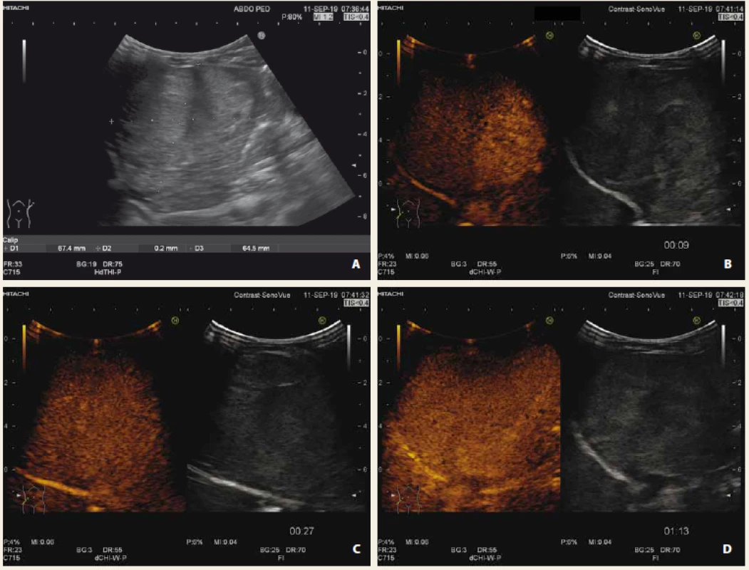Hepatoblastom nativně, B mód (A), CEUS arteriální fáze (B), portální fáze (C), pozdní fáze (D) s vymýváním kontrastní
látky „wash out“ fenomén. Signifikantně zvýšená hladina alfa-fetoproteinu.<br>
Fig. 4. Liver hepatoblastoma native US, B-mode (A), CEUS arterial phase (B), portal phase (C), late phase (D) with „wash out“
of contrast agent. Significant elevation of alpha-fetoprotein.