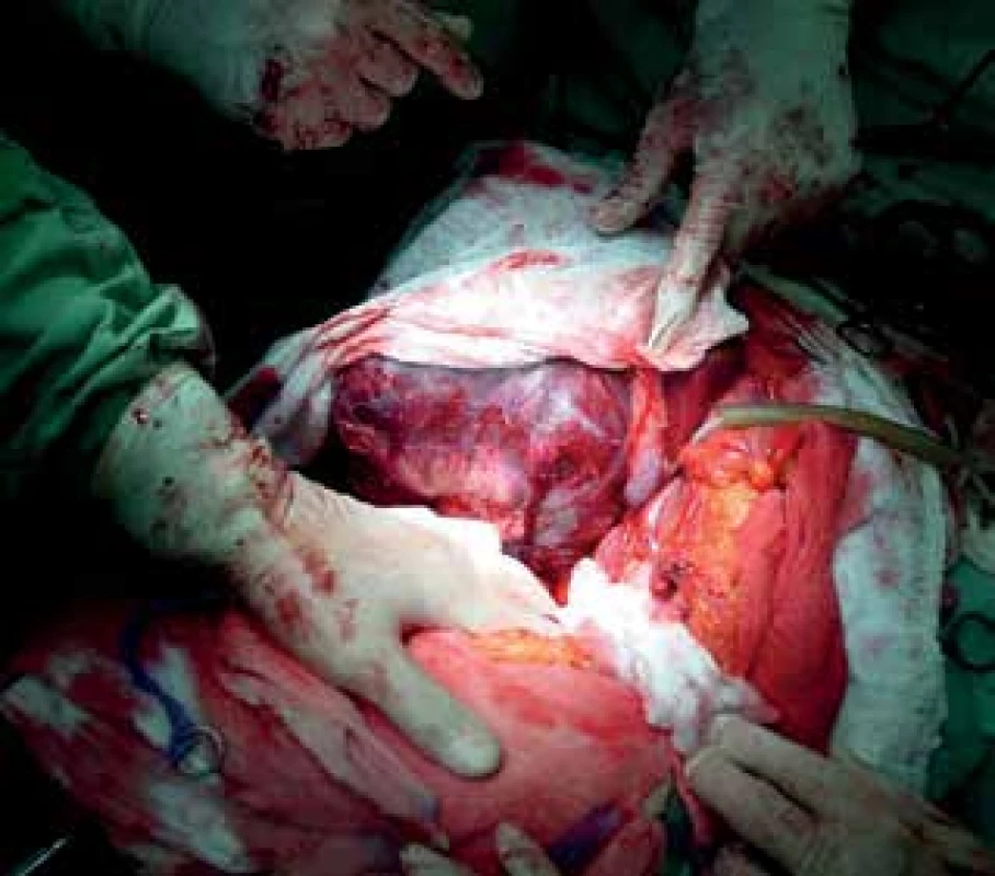 Velký nádor jater<br>
Fig. 3: Large liver tumor