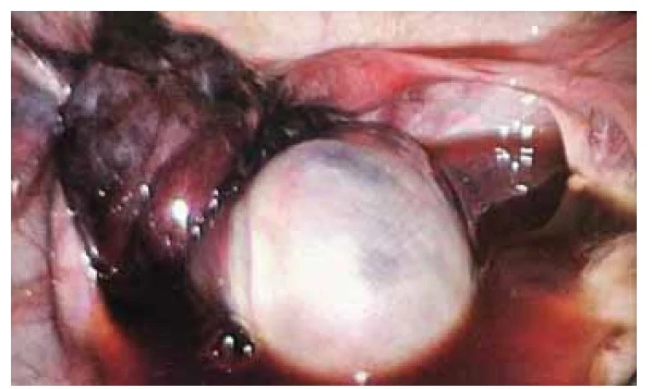 Ovarium změněné edémem při torzi adnex.<br>
Fig. 2. Ovary with edematous changes in adnexal torsion.