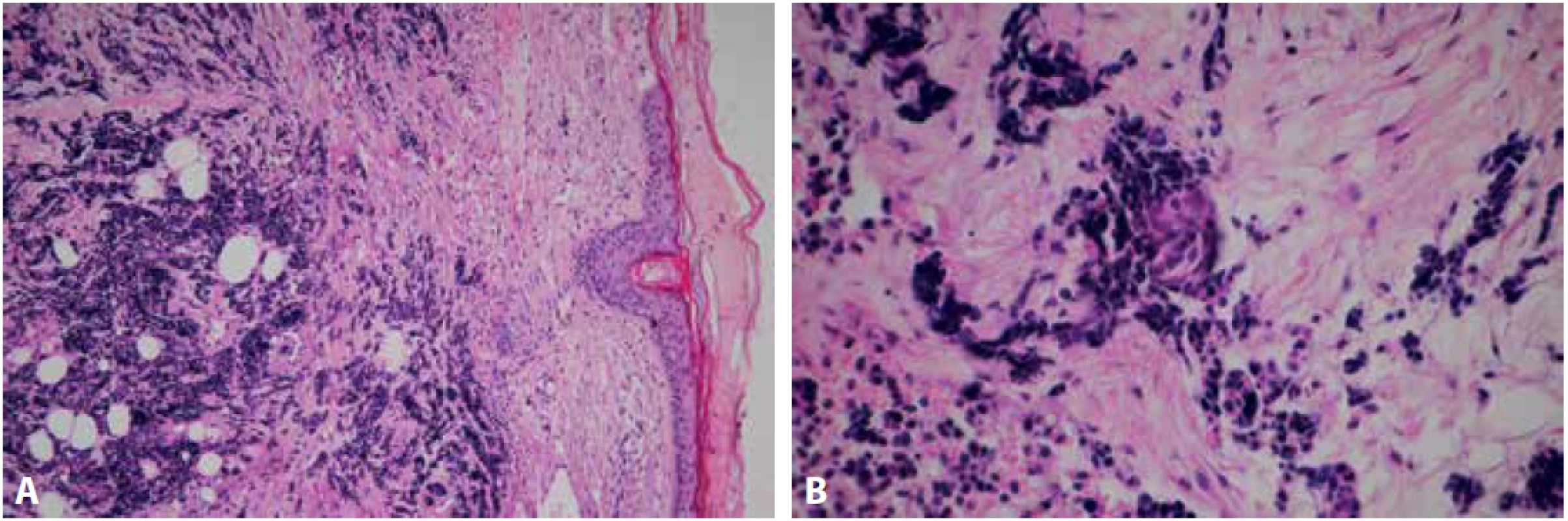 Intradermální solidně trabekulární nádorový infiltrát tvořený drobnými hyperchromními elementy. Epidermální kryt je atrofický, ale intaktní (A – barvení hematoxylinem eozinem, zvětšení 100x). Drobné ložisko skvamózní diferenciace (B – barvení hematoxylinem eozinem, zvětšení 200x).