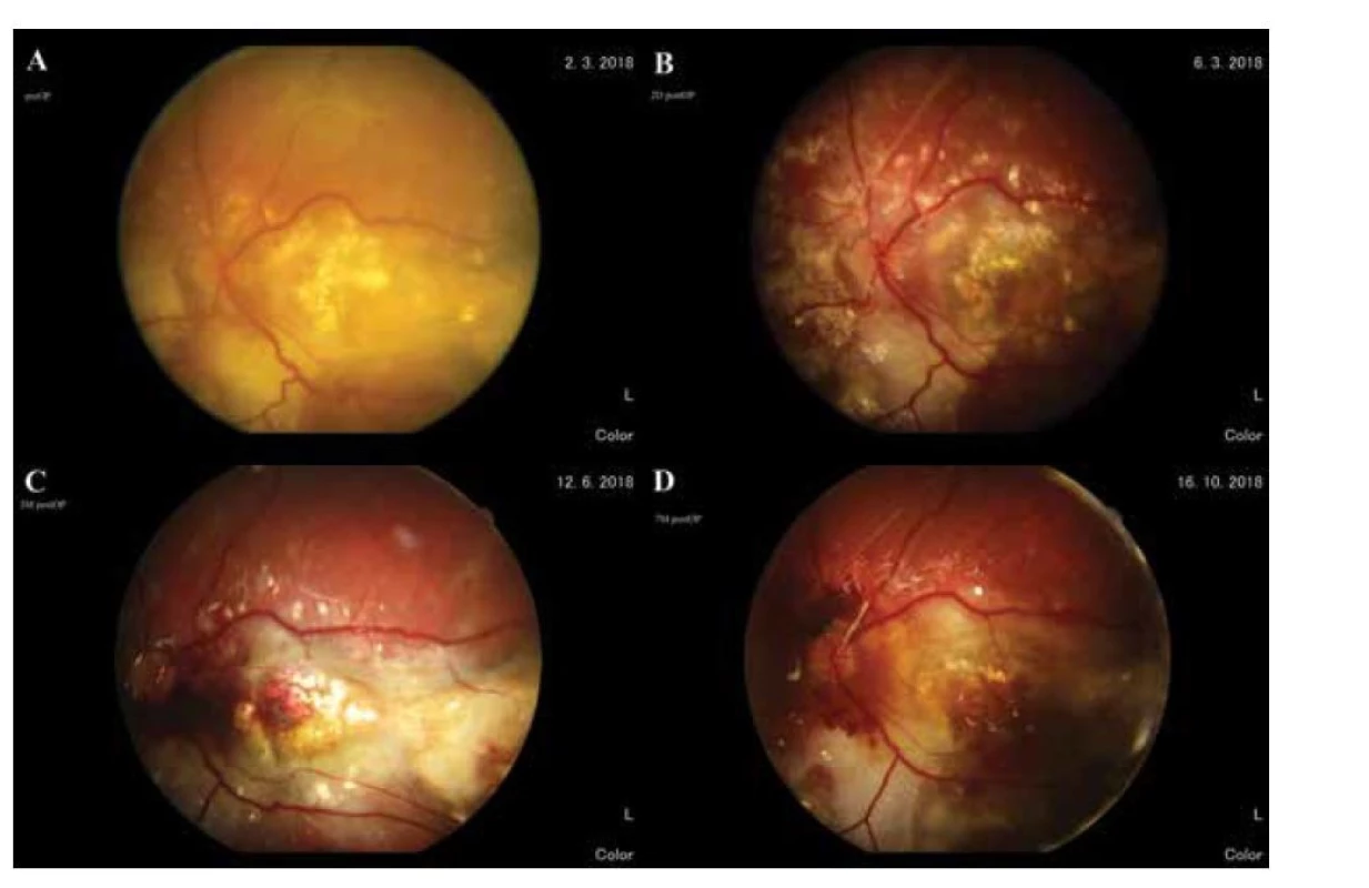 Makula. (A) pred operáciou, (B) 2 dni po operácii, (C) 3 mesiace po operácii, (D) 7 mesiacov po operácii