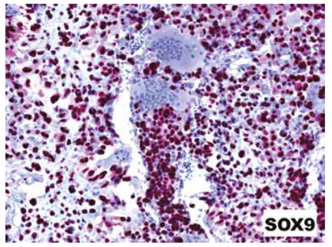 Difúzní jaderná pozitivita s protilátkou SOX9 přítomná jak v chondroidních
oblastech, tak v malých stromálních buňkách dělících sept; reaktivní
osteoklasty byly vždy negativní (IHC; 200x).