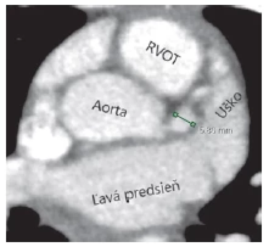 CTA 10-ročného
pacienta dlhodobo sledovaného
po prekonaní
Kawasakiho choroby.
Axiálna rovina. Zelená
úsečka ukazuje diameter
aneuryzmaticky dilatovanej
ľavej koronárnej artérie.
Na základe jej nameraného
diametra a jeho
zaindexovaní na povrch
tela bola u pacienta podľa
aktuálnych odporúčaní(14)
zmenená antikoagulačná
liečba na duálnu antitrombotickú
liečbu.