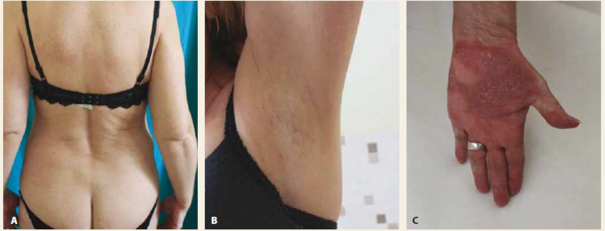 Kožný nález bez prejavov guttátnej psoriázy, prejavy hidradenitis suppurativa takmer v kompletnej regresii, pretrváva
palmoplantárna pustulóza (C) 27. 11. 2018.<br>
Fig. 3. Skin finding without guttate psoriasis, hidradenitis suppurativa almost complete regression, palmoplantar pustulosis
persists (C) 27th of November.