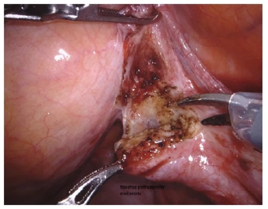 Resekce postiženého místa močovodu <br> 
Fig. 2. Resection of the affected ureter