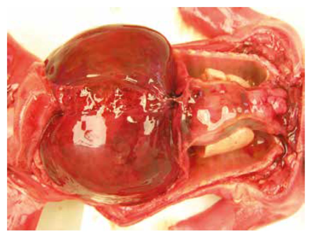 Prípad 3: Hepatomegália, hypoplázia pľúc.