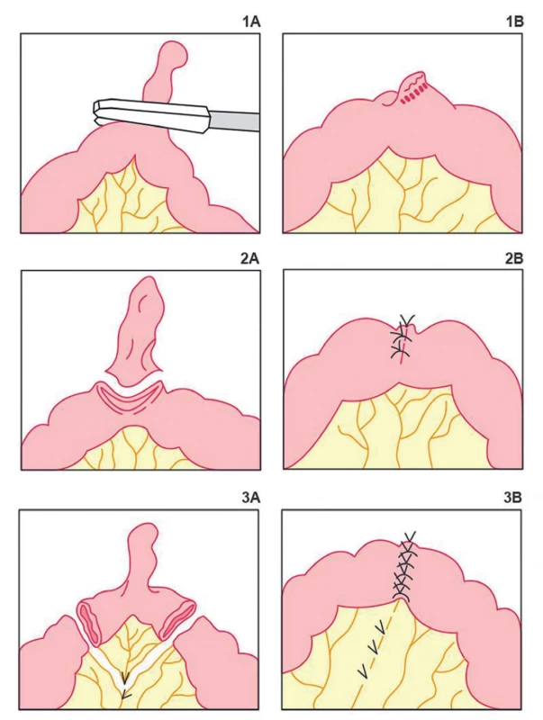 Typy resekčných výkonov Meckelovho divertiklu: 1A−1B – transverzálna divertikulektómia; 2A–2B – klinovitá resekcia;
3A–3B – segmentálna resekcia<br>
Fig. 1. Types of resection for Meckel’s diverticulum: 1A−1B – transversal diverticulectomy; 2A−2B – wedge resection;
3A−3B – segmental resection
