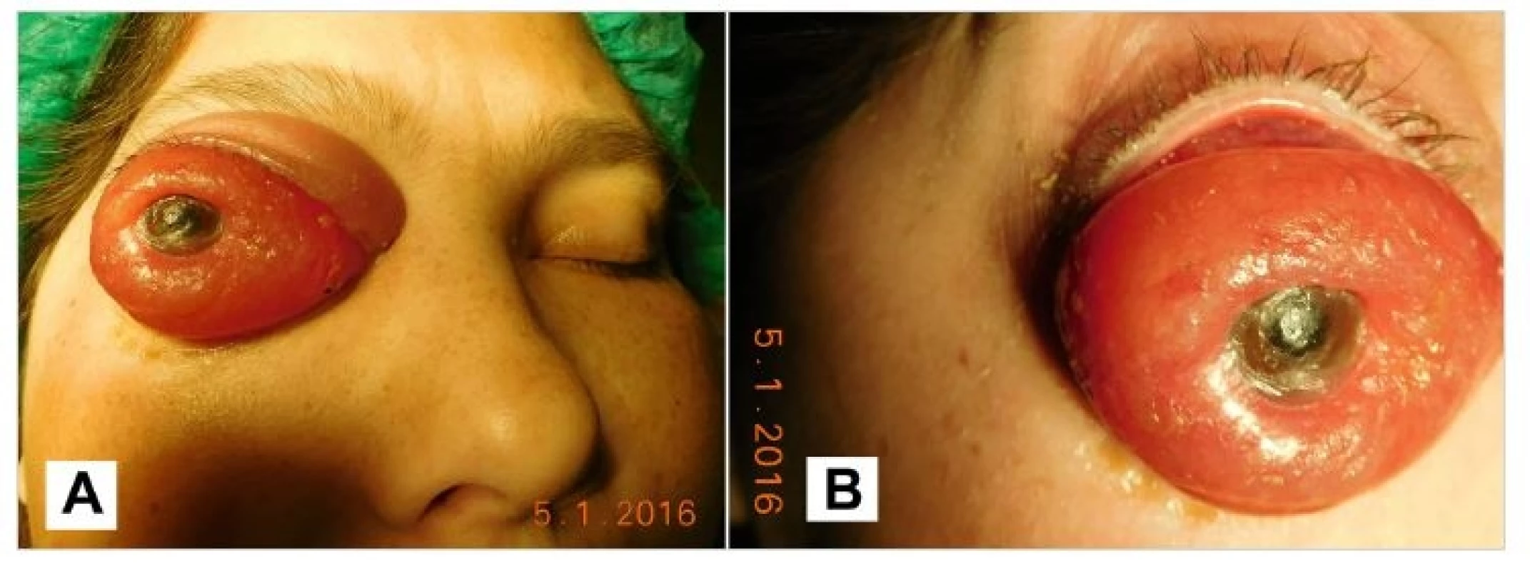 Macrophoto 1/2016 before surgery (A), detail of the eye globe (B)