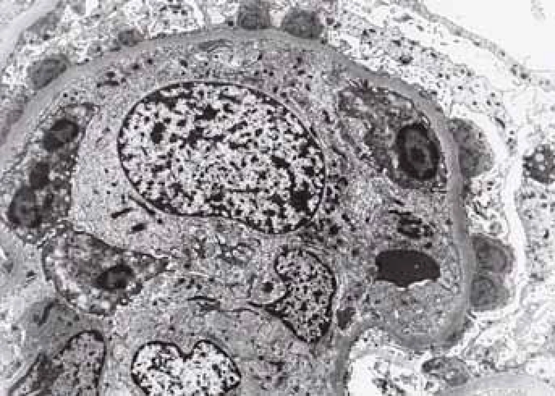 Histologické nálezy u pacientů s IBD a renálním postižením (tubulointersticiální nefritida, glomerulonefritida, AA amyloidóza).<br>
Fig. 6. Biopsy pictures in IBD patients with renal illness (tubulointerstitial nephritis, glomerulonephritis, AA amyloidosis).