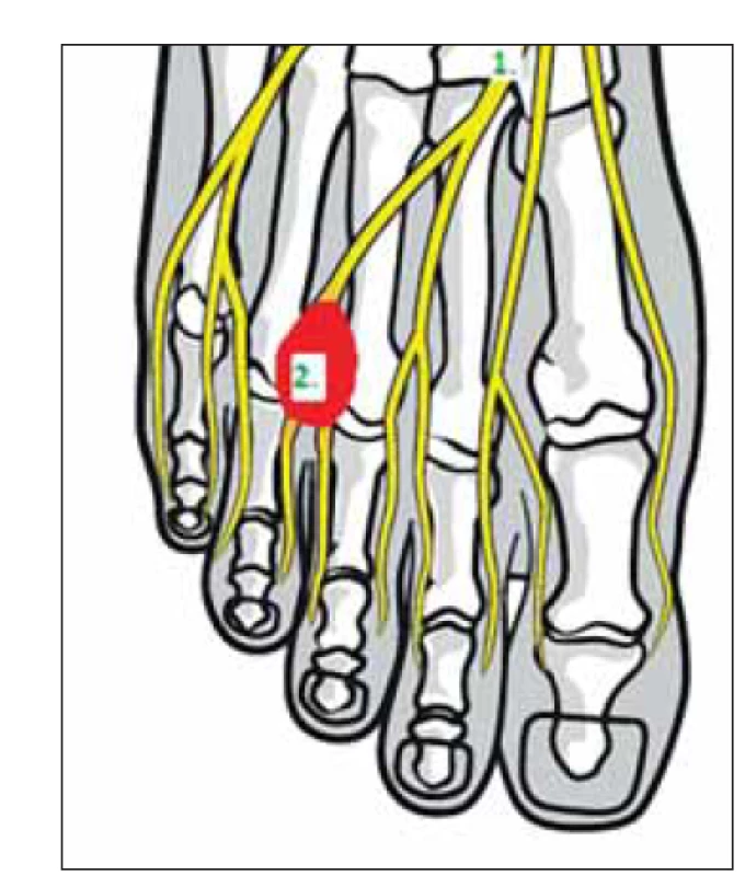 Anatomie planty – (1) n. digitalis
plantaris communis; (2) červeně Mortonův
neurom.<br>
Fig. 1. Plantar foot anatomy – (1) common
plantar digital nerve; (2) Morton’s neuroma
(red).