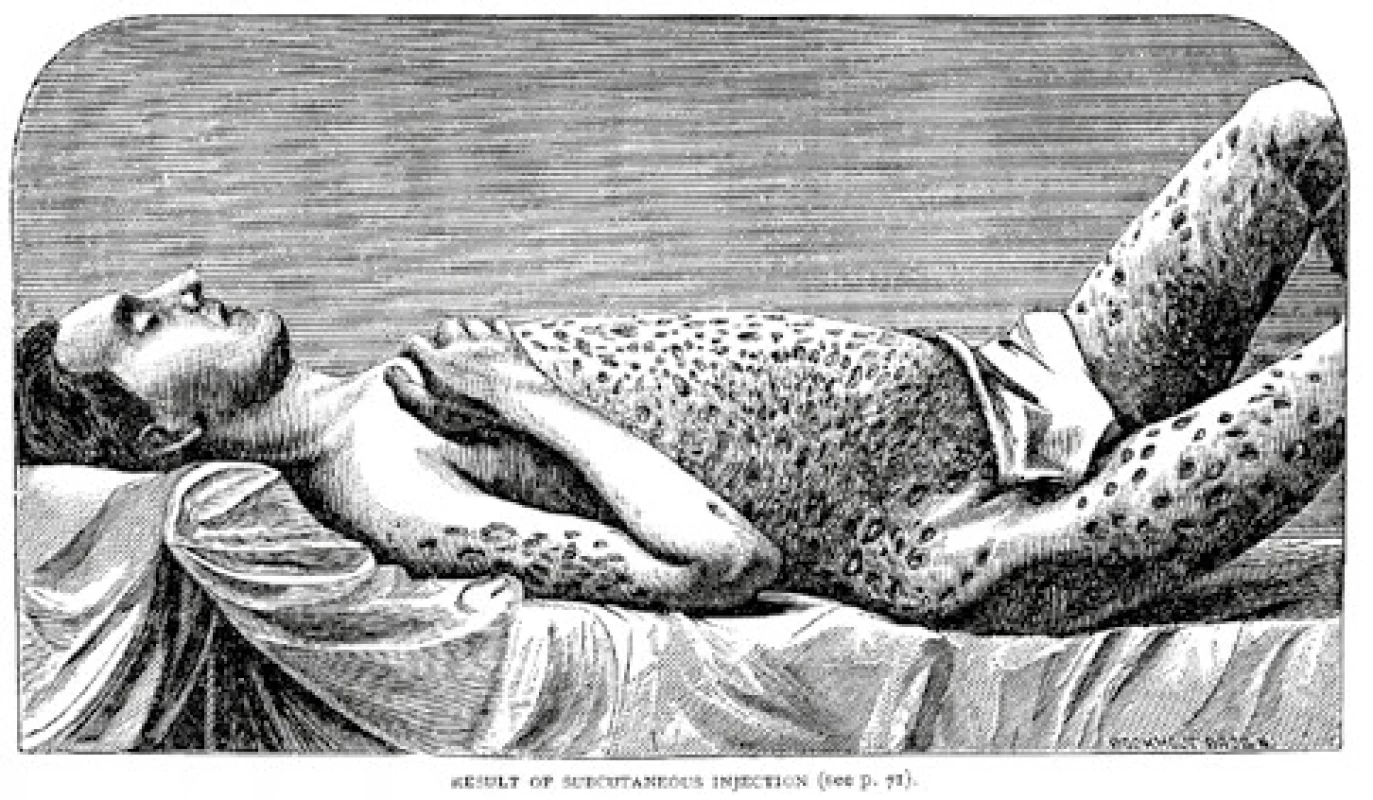 Obrázek varující před injekčním zneužíváním morfinu – následky
podkožních injekcí. Zdroj: Wikimedia Commons (CC BY 4.0)