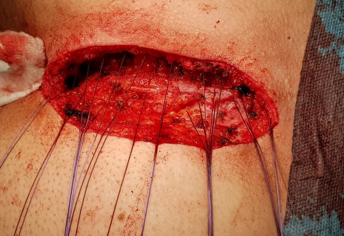 První vrstva stehů<br>
Fig. 5: First layer of the suture