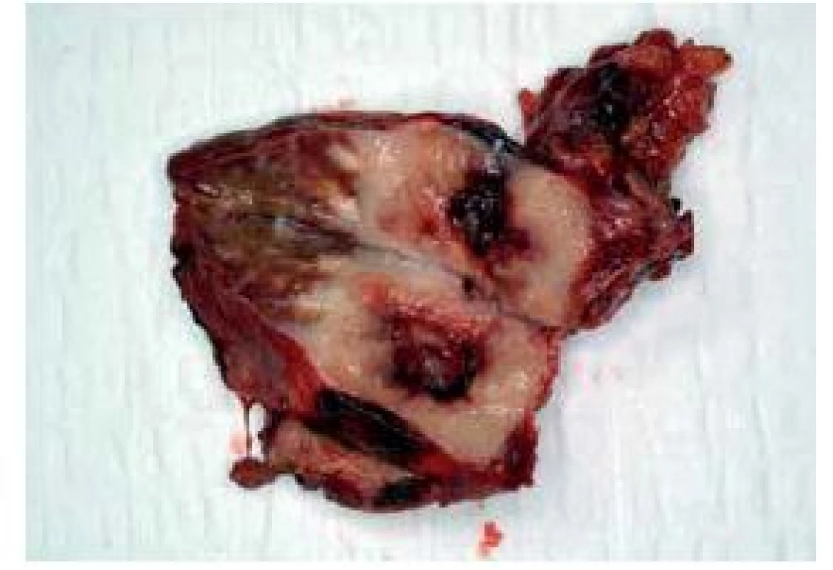 Finding during the second surgical intervention