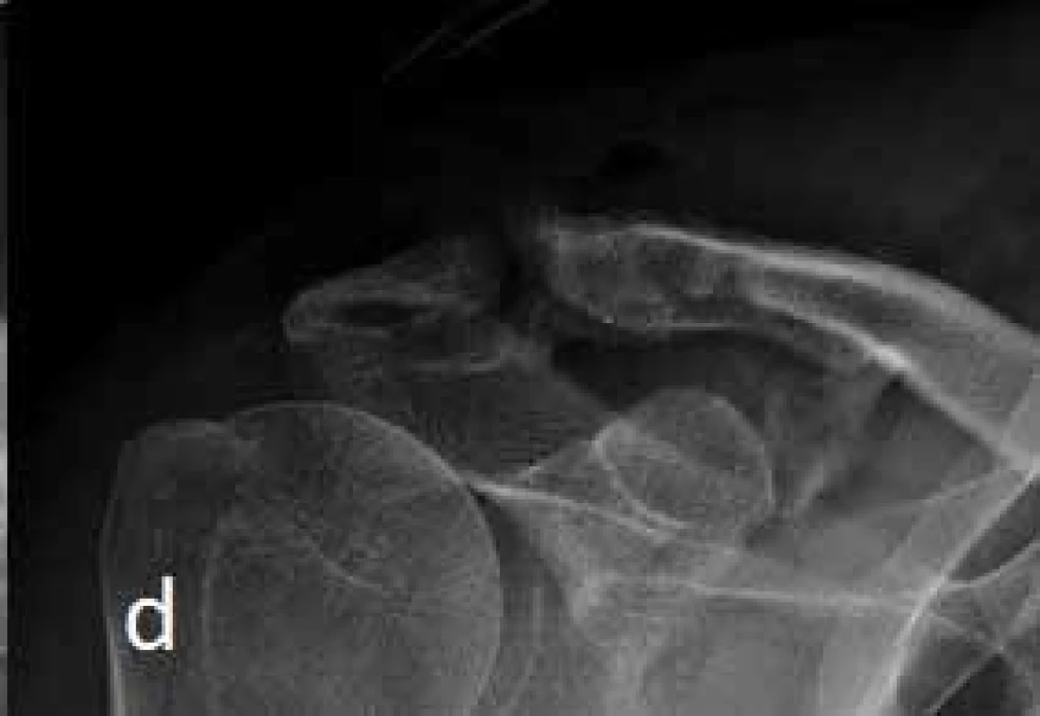 Man, aged 58, Rockwood type III AC dislocation after a fall of a bicycle; a) Post-traumatic images, b) Condition at 1 month after surgery after stabilization by hook plate in anatomical position in AC articulation, c) Condition at 3 months after surgery: acromial pressure osteolysis visible, d) Resulting post-treatment condition at 6 months after surgery showing arthritic changes in the AC articulation