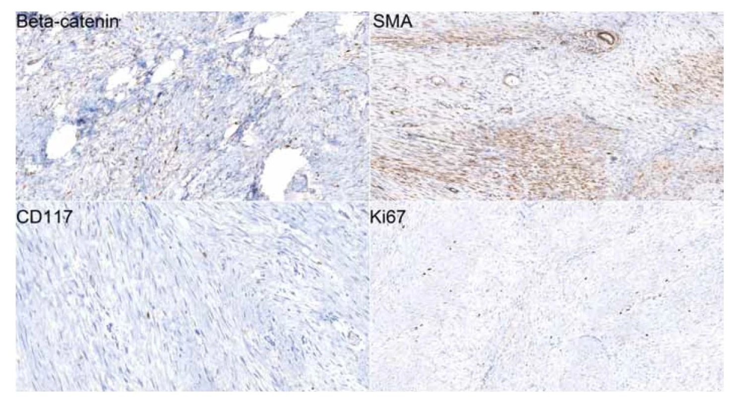 Imunohistochemické preparáty (20x) dokumentující jadernou pozitivitu beta-cateninu a cytoplazmatickou pozitivitu
hladkosvalového aktinu (SMA) ve významné části buněčnosti léze. CD117 (c-kit) je v buňkách léze negativní, je patrná
membránová pozitivita žírných buněk coby vnitřní kontrola. Proliferační aktivita (Ki67) léze je nízká s pozitivitou nepřesahující
5 % buněk.<br>
Fig. 3. Immunohistochemical slides (20x) showing beta-catenin nuclear positivity and cytoplasmic positivity of smooth muscle
actin (SMA) in a signifi cant part of the cellular lesion. CD117 (c-kit) is negative in tumorous cells, membrane positivity of mast cells
which was used as means of internal control is evident. The proliferative activity (Ki67) of the tumor is low with cellular positivity not
exceeding 5%.