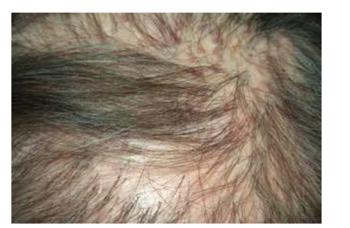 Lichen planopilaris kštice: jizvící alopecie, folikulárně
vázané červenofialové makulopapuly