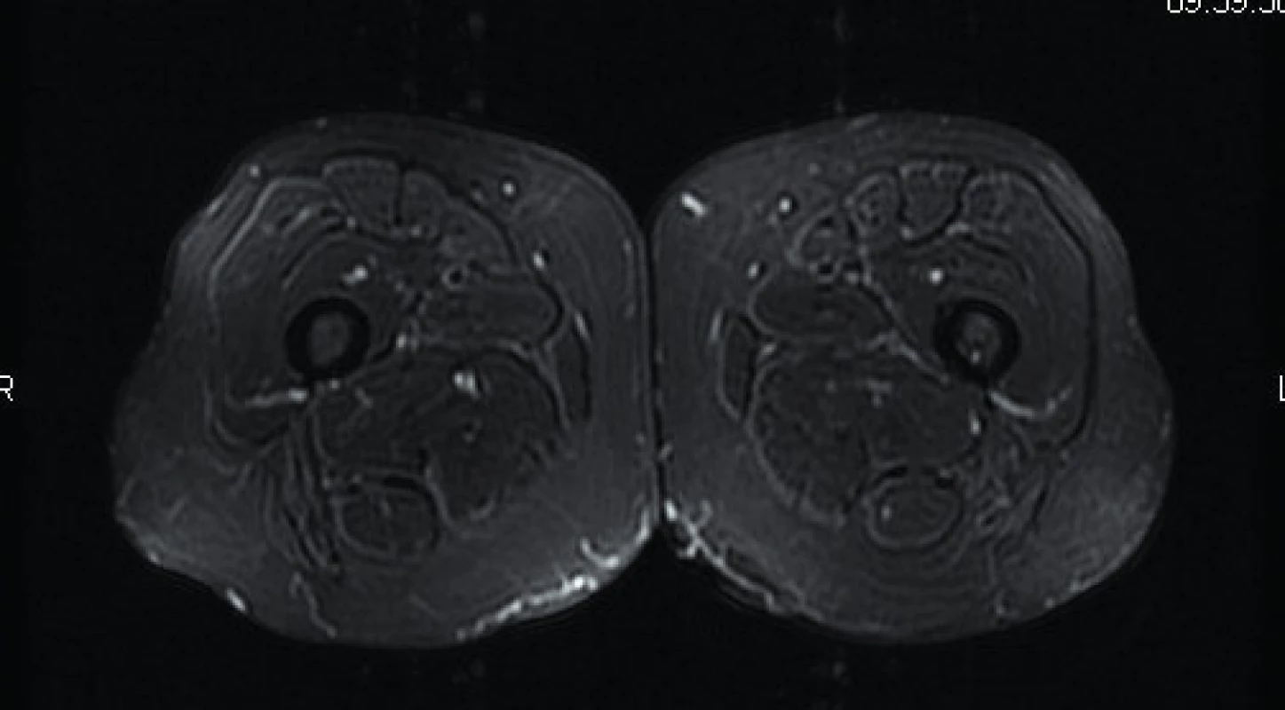 Axiální STIR (short tau inversion recovery) sekvence – zdravý sval. Zdroj: Archiv Revmatologického ústavu (ÚVN Střešovice, Discovery 450; 1,5 T)