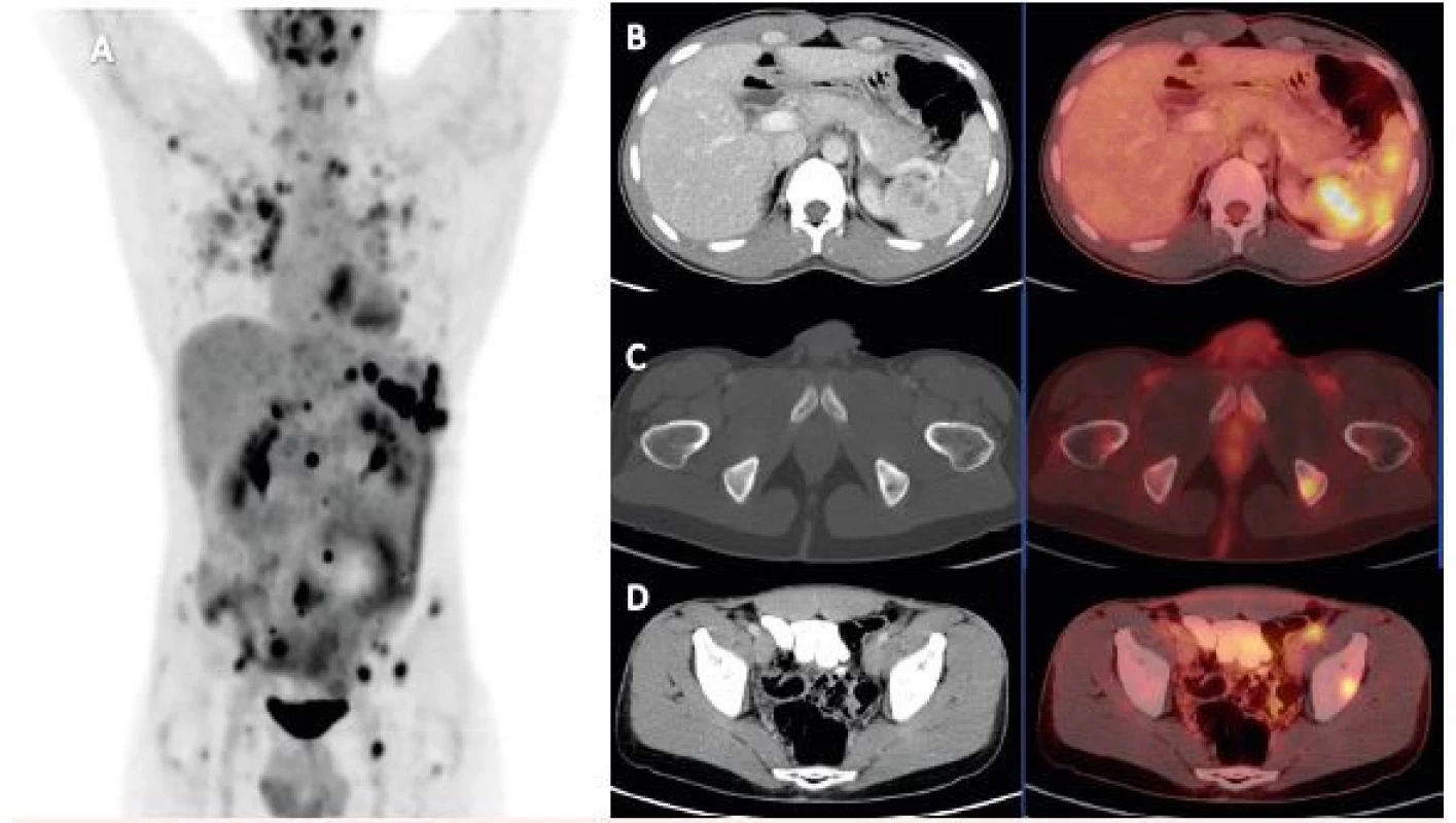 FDG-PET/ CT vyšetření pacienta s histologicky prokázanou sarkoidózou
A) FDG-PET/CT vyšetření detekující mnohočetná metabolicky aktivní ložiska v plicích, slezině, lymfatických
uzlinách a kostech – MIP PET trup.
B) Axiální řez CT a PET/CT nezvětšené sleziny prostoupené hypodenzními splývajícími, metabolicky aktivními
ložisky velikosti do 17 mm, SUVmax do 8,5.
C) Axiální řez CT a PET/CT v místě metabolicky aktivního osteolytického ložiska v levé sedací kosti 11 mm
v průměru, SUVmax 5,6.
D) Axiální řez CT a PET/CT v místě ovoidní uzliny ventrálně od společného ilického cévního svazku vlevo
velikosti 12 x 8 mm v příčném průměru, SUVmax 5,6.