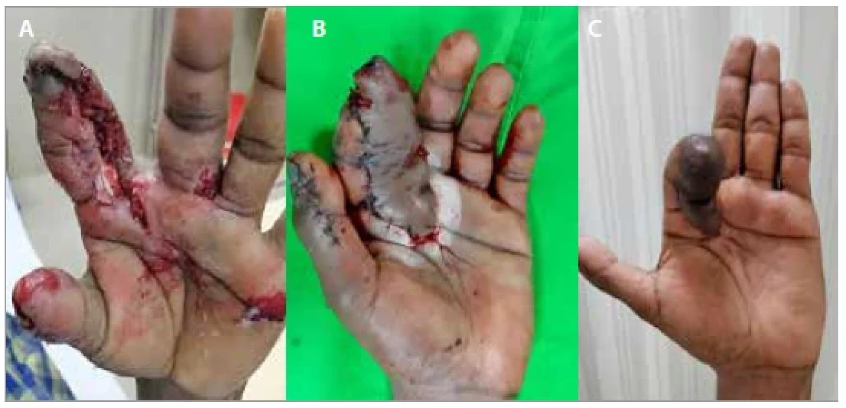 (A) Crush injury of the index finger with soft tissue loss over the distal,
middle and the proximal phalanx with flexor tendons exposed; (B) posterior
interosseous flap inset, an interposition vein graft was used and anastomosed
to the common digital vessel; (C) late postoperative picture of 6 months.