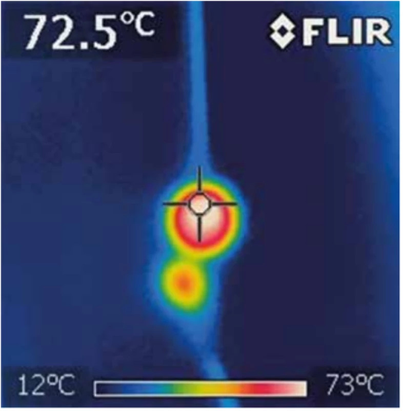  Absorpce laserového paprsku na hrotu světlovodu
v želatině termokamerou – srovnání DL 1470 a 1940 nm
V experimentu je patrná menší penetrace laserového paprsku DL 1940 nm (dolní).<br>
Fig. 1: Absorption of laser beam in jelly visualized by thermal camera – comparison of DL 1470 and 1940 nm
A lower penetration level of the 1940nm laser (DL) was demonstarted in the experiment (lower beam).