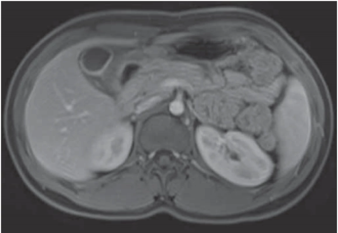 MRI – marked thickening of the duodenal wall with
retraction to the gallbladder.<br>
Obr. 1. MR – zesílení stěny duodena, které je retrahováno ke
žlučníku.