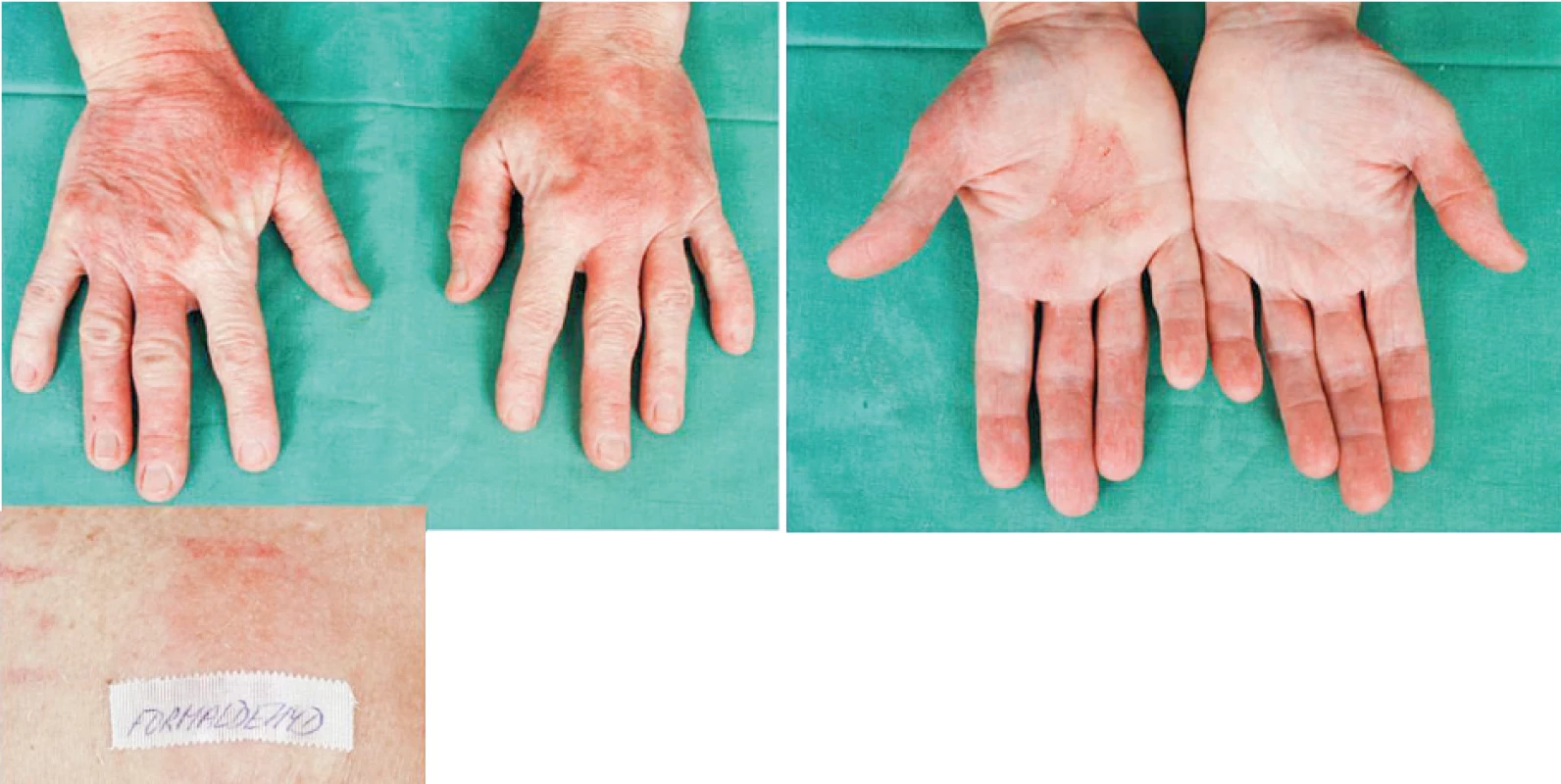 Eczema contactum et atopicum – Quaternium-15++-+++, formaldehyd+++ (kosmetické
přípravky), 1,3,5-tris(2-hydroxyetyl)-hexahydrotriazin++, Bioban CS1135++, Bioban CS1246+++, thiomersal++
– uklízečka