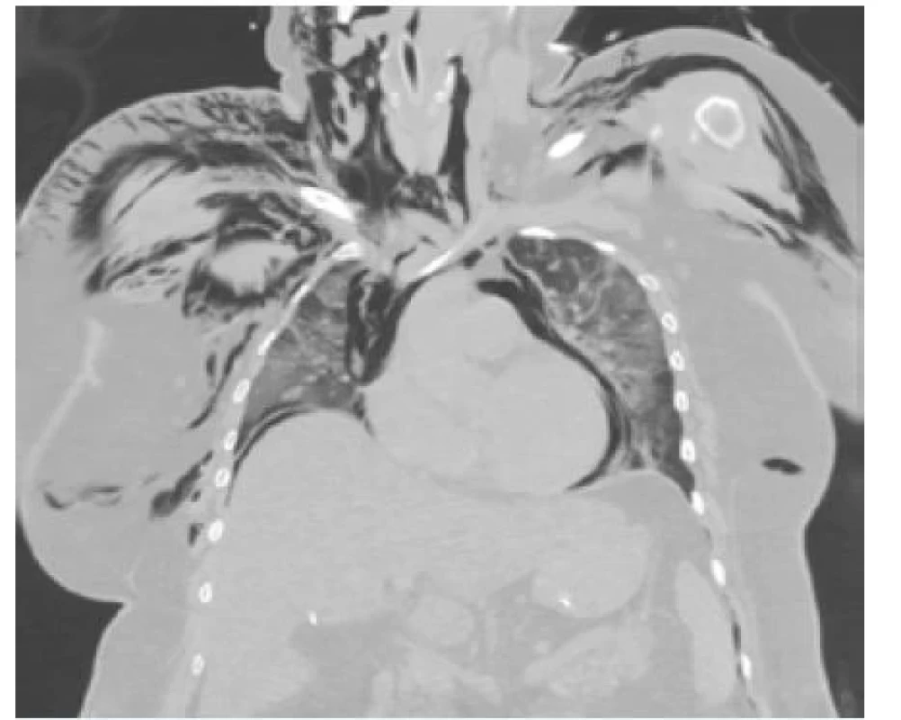Sekundární pneumomediastinum jako následek
perforace trachey