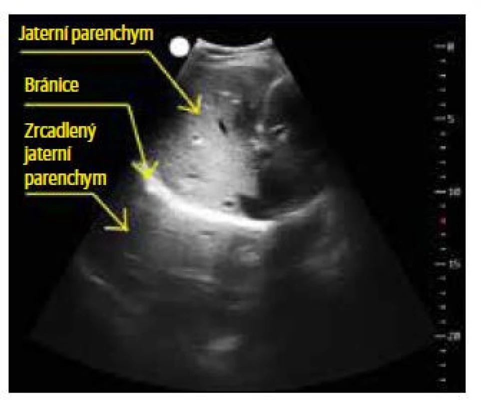 Zrcadlení jaterního parenchymu za bránicí.
V prostoru za bránicí vidíme některé typické
anatomické struktury jaterního parenchymu.