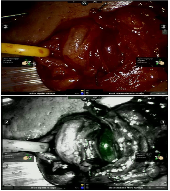 a, b. Zobrazení artérie při mikroskopické varikokélektomii před (a) a po aplikaci ICG (b)<br>
Fig. 3a, b. Imaging of artery before (a) and after the application of ICG (b) during microvaricocelectomy