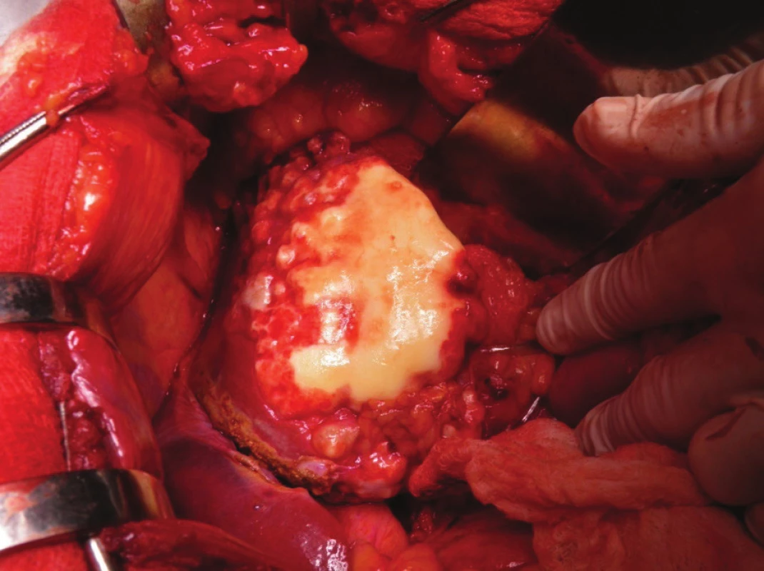 Peroperačný nález<br>
Fig. 5: Peroperative finding