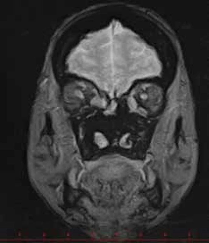 Myositis of the rectus medialis and inferior oblique muscles,
more pronouncedly in the right eye