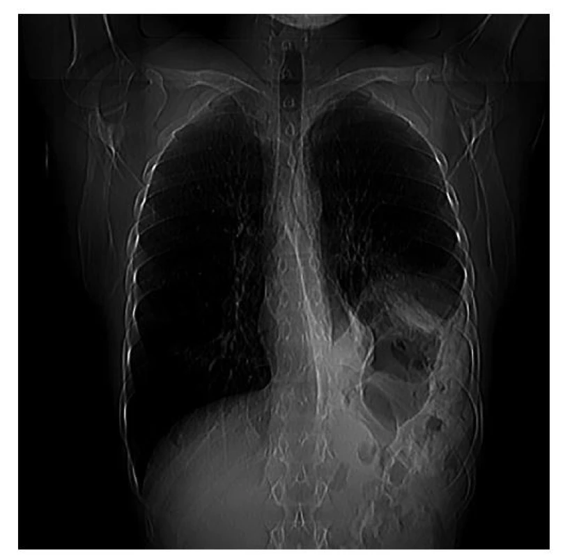 Herniace útrob do levé pleurální dutiny na CT topogramu<br>
Fig. 1: Visceral herniation in the left pleural cavity based
on CT topogram