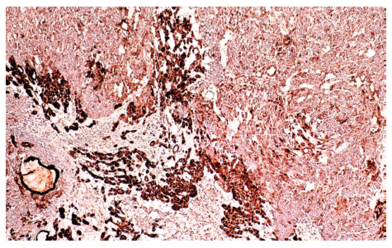 Imunohistochemická exprese cytokeratinu 7 (CK7)
v synoviálním sarkomu